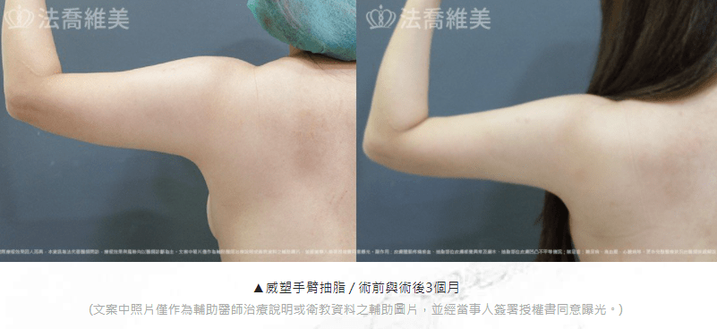 手臂抽脂 大方的穿上無袖上衣吧！