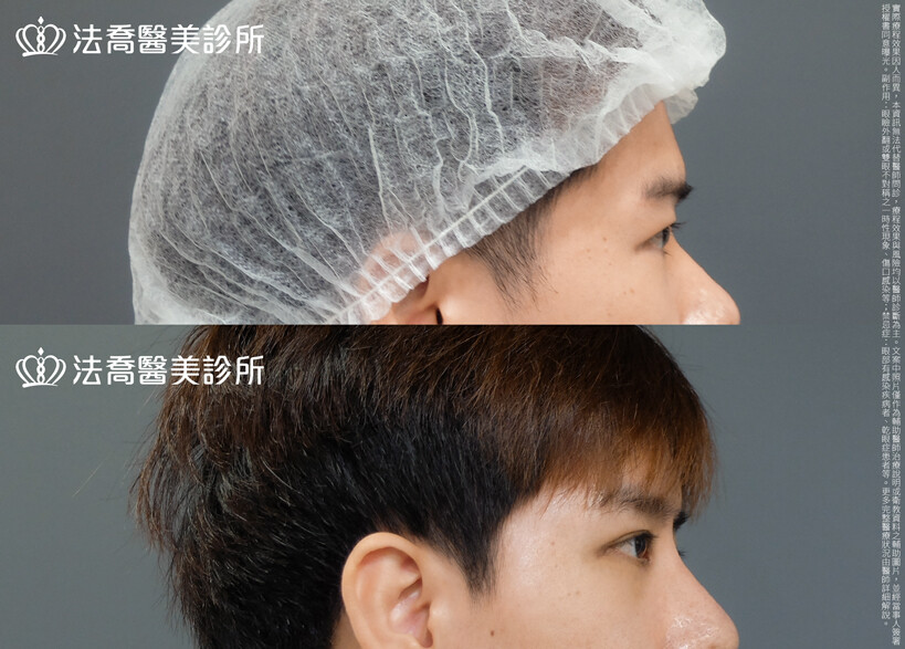 法喬醫美診所,邱浚彥,割雙眼皮