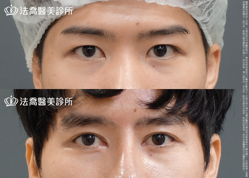 法喬醫美診所,邱浚彥,割雙眼皮