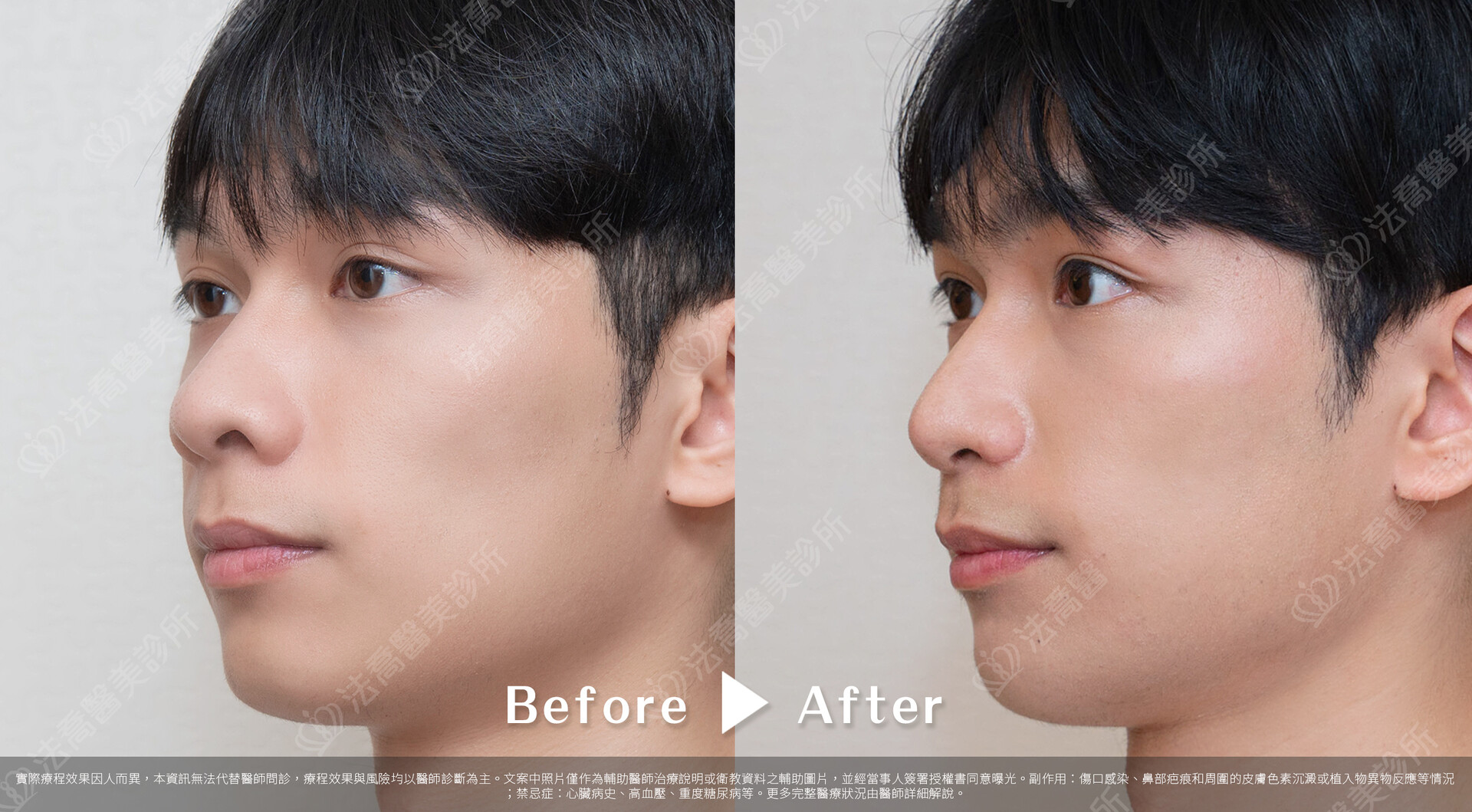 自體肋骨隆鼻,法喬醫美診所,邱浚彥