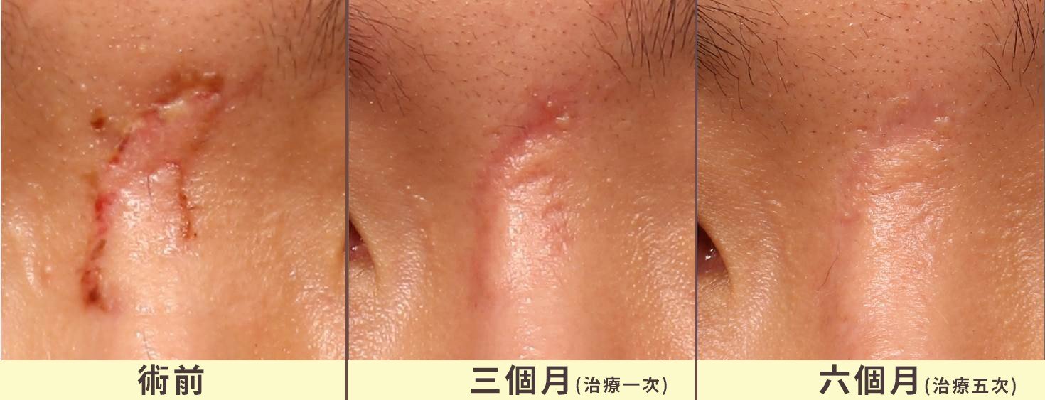 鼻樑外傷疤痕治療