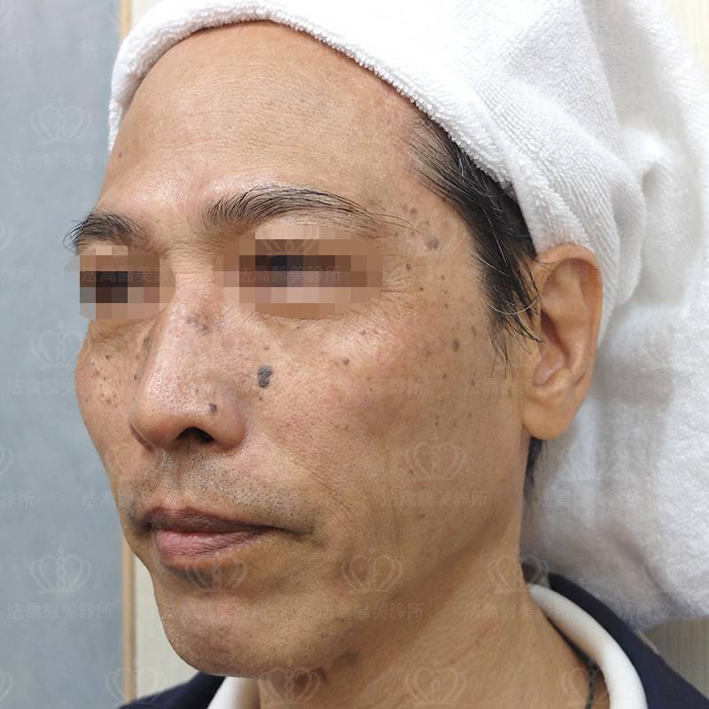 淨膚雷射前