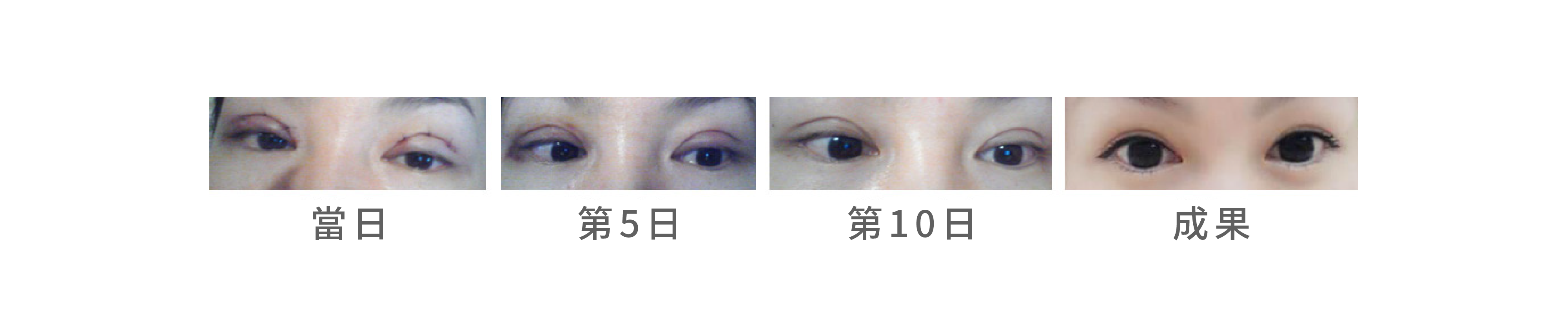 三切口雙眼皮恢復狀況