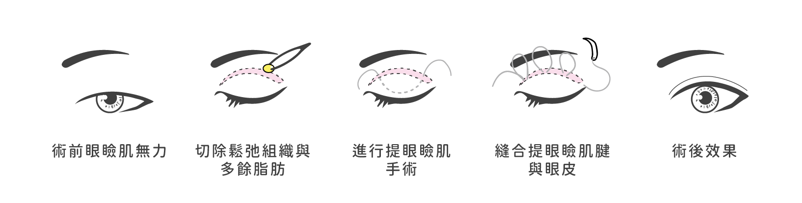割雙眼皮合併提眼瞼肌提拉術方式