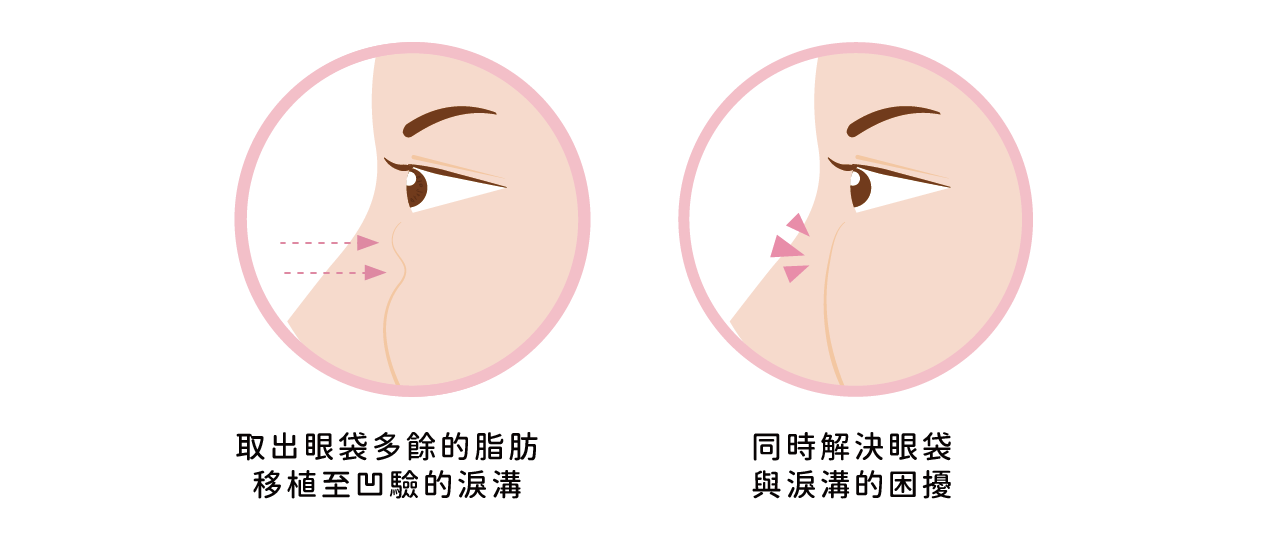 眼袋手術合併脂肪移位