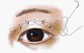 縫雙眼皮方式