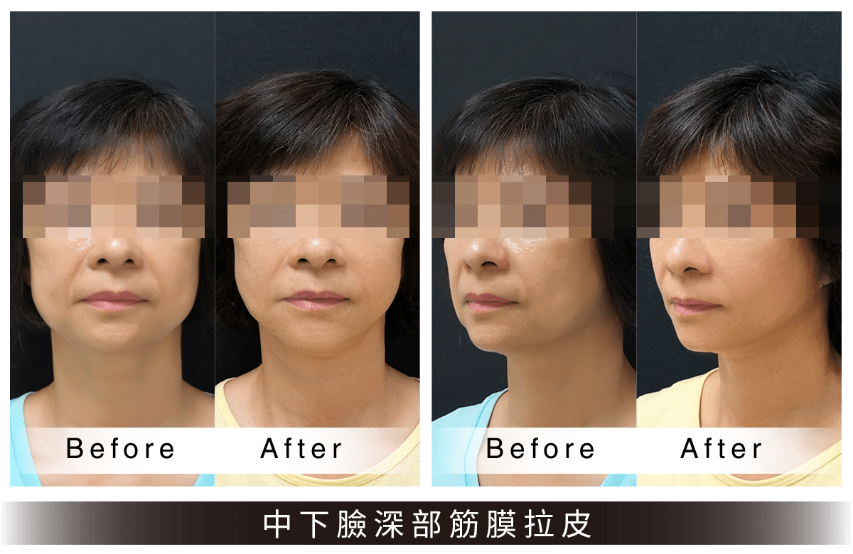 中下臉深部筋膜拉皮前後比對