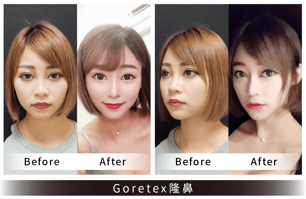 Goretex隆鼻案例