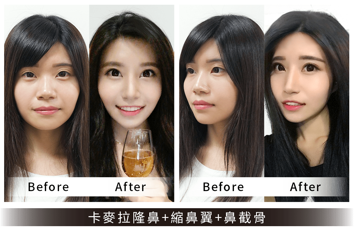 卡麥拉隆鼻/縮鼻翼案例