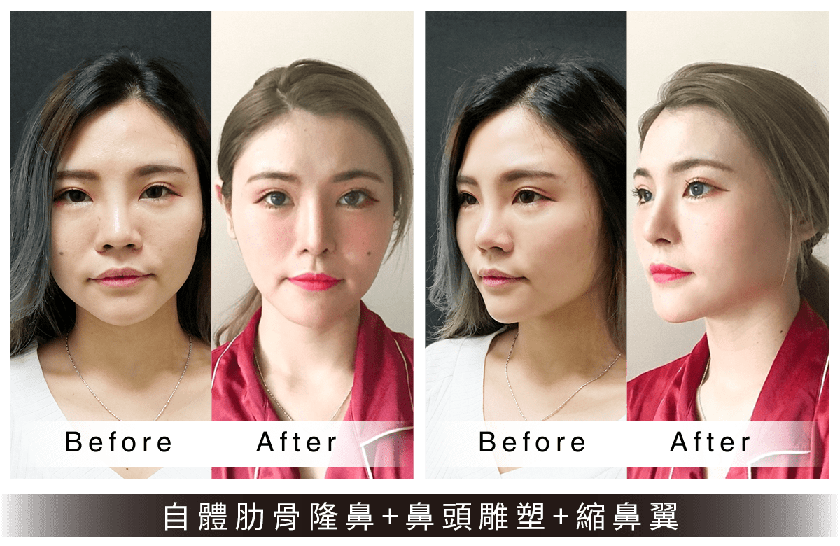 自體肋骨隆鼻/縮鼻翼案例
