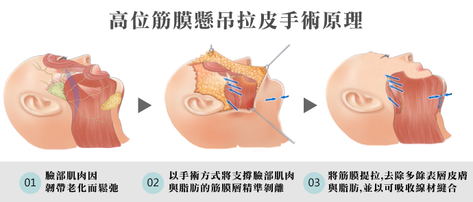高位筋膜懸吊拉皮原理