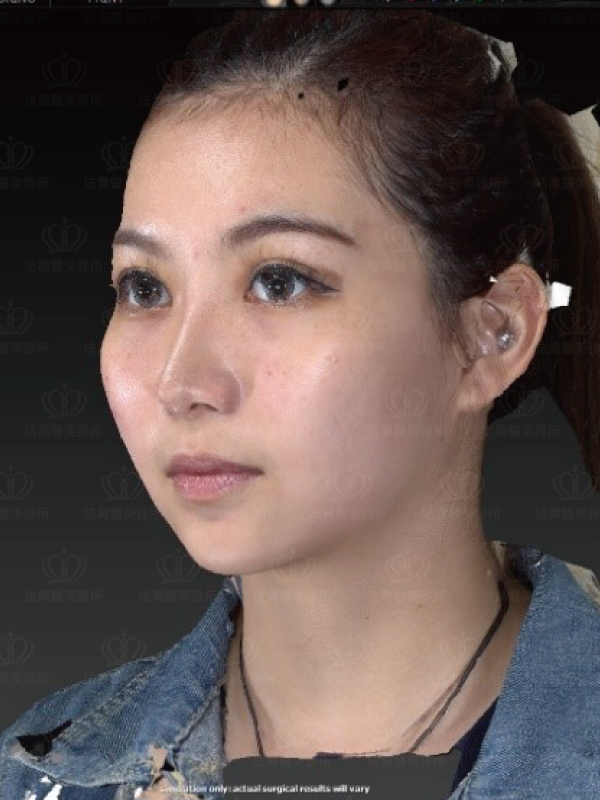 3D影像模擬自體肋骨隆鼻