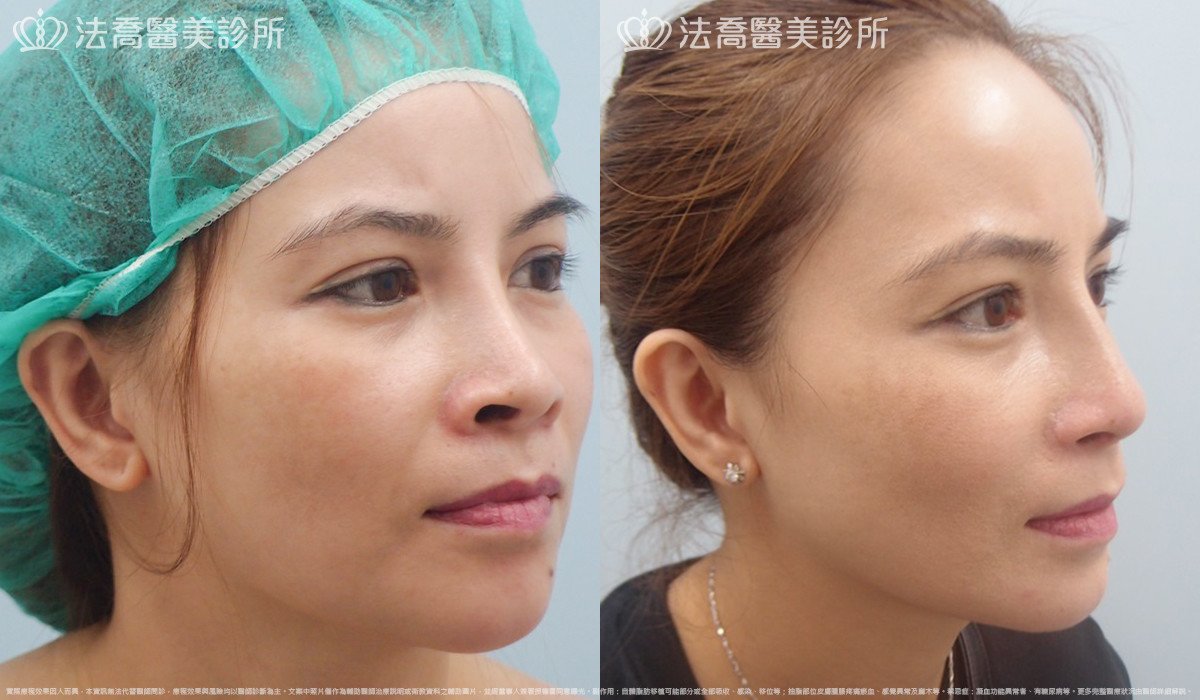 法喬醫美診所,邱浚彥,人工骨下巴