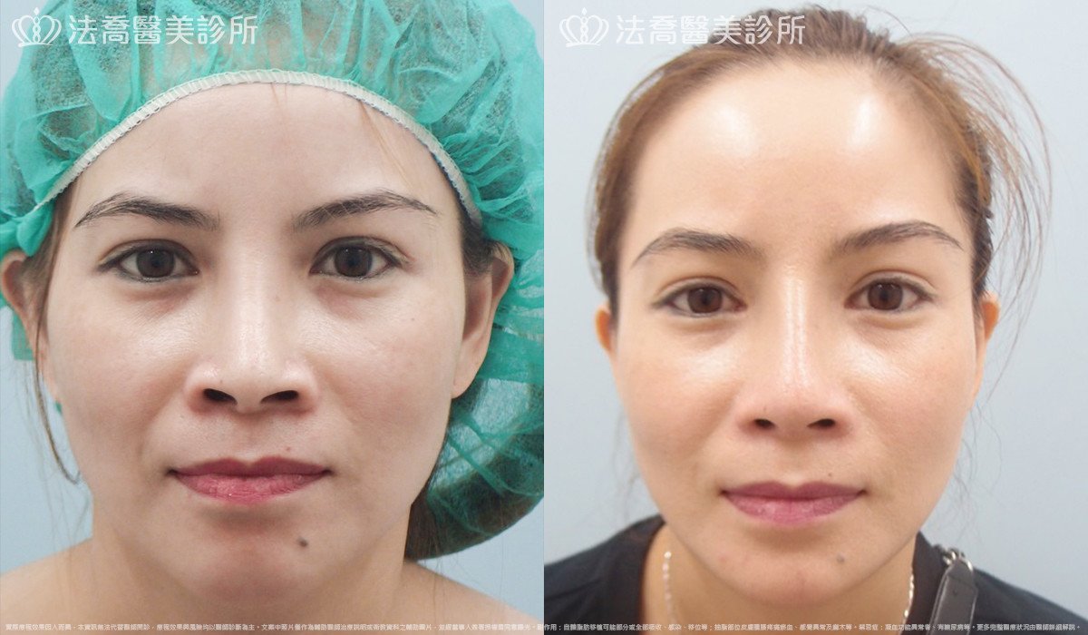 法喬醫美診所,邱浚彥,人工骨下巴