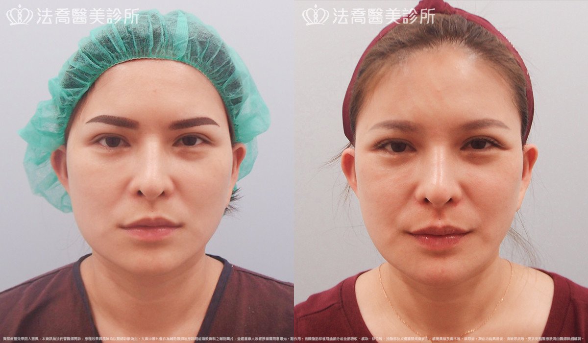 法喬醫美診所,邱浚彥,人工骨下巴