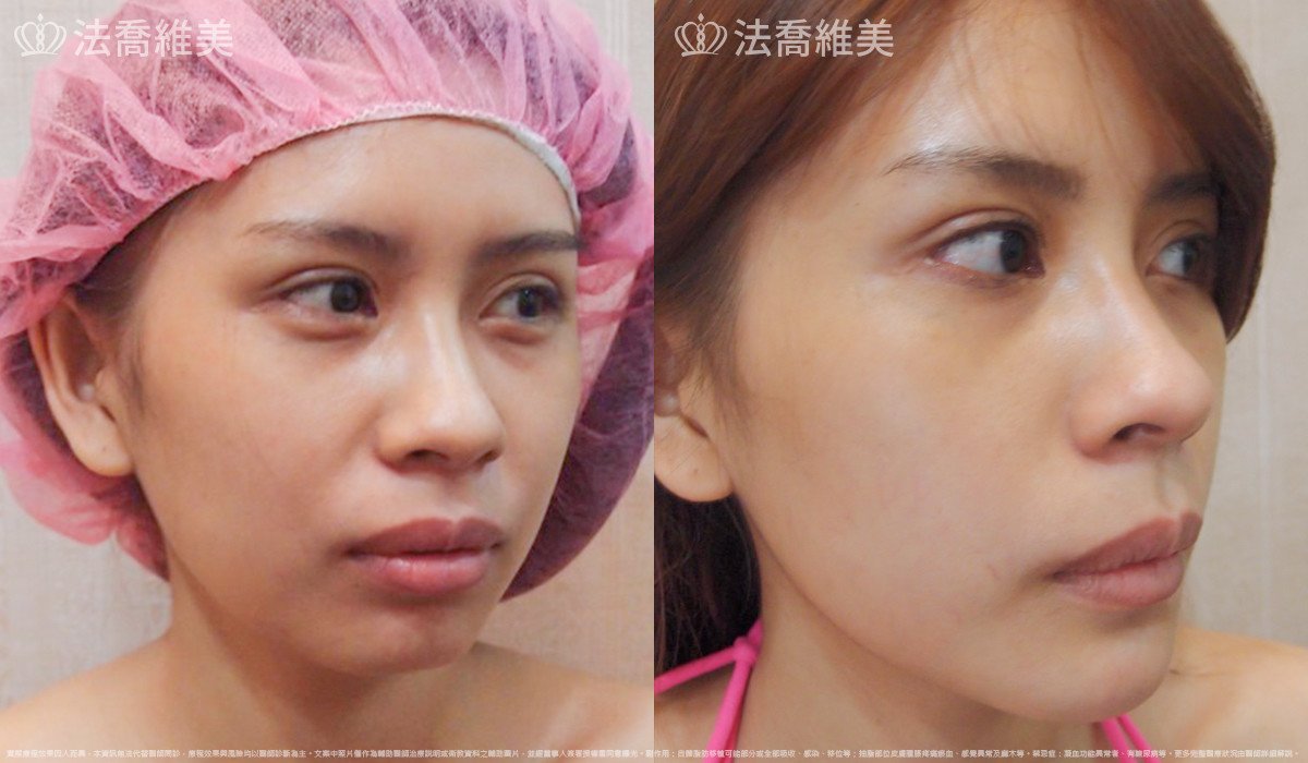 法喬醫美診所,邱浚彥,人工骨下巴