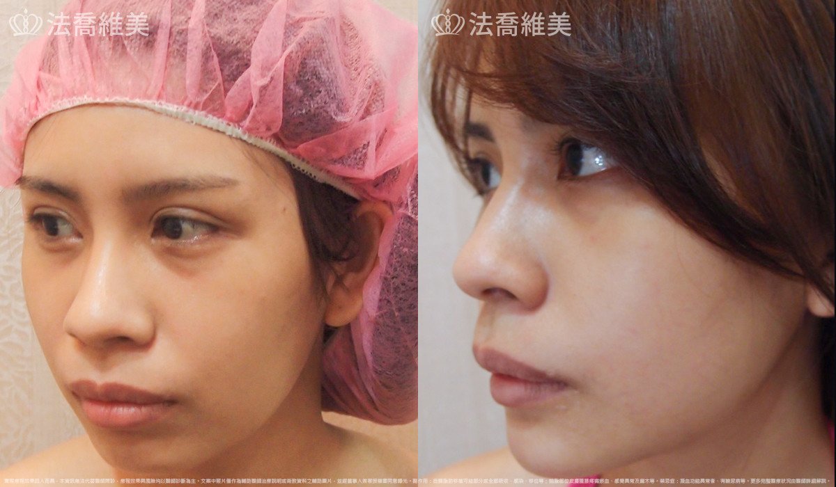 法喬醫美診所,邱浚彥,人工骨下巴