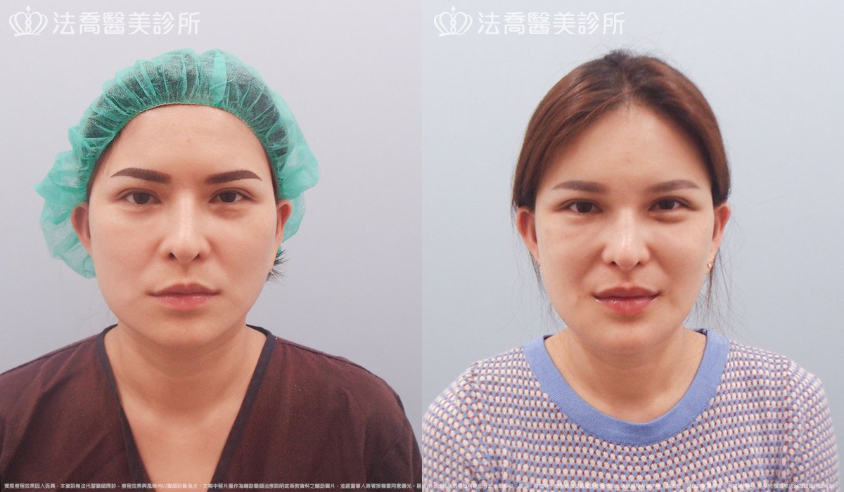 法喬醫美診所,邱浚彥,下顎角削骨