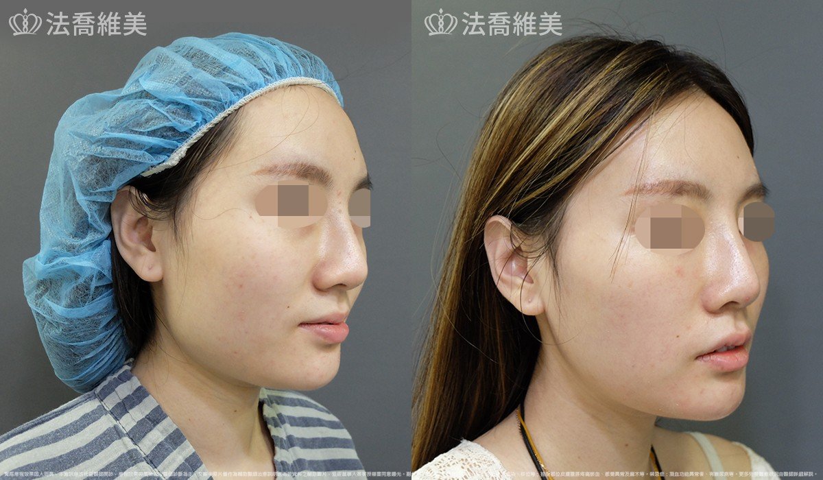 法喬醫美診所,邱浚彥,下顎角削骨