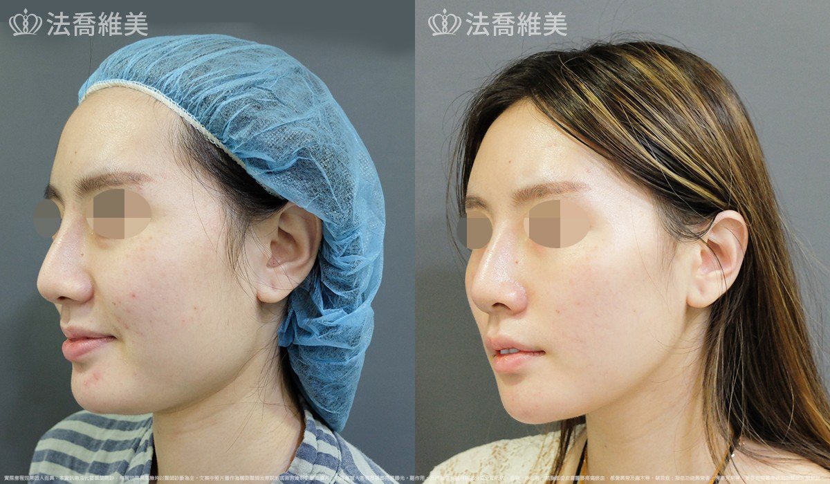 法喬醫美診所,邱浚彥,下顎角削骨