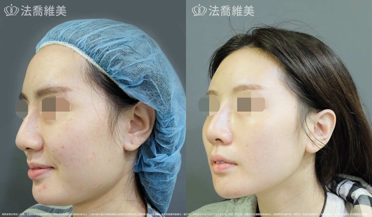 法喬醫美診所,邱浚彥,下顎角削骨