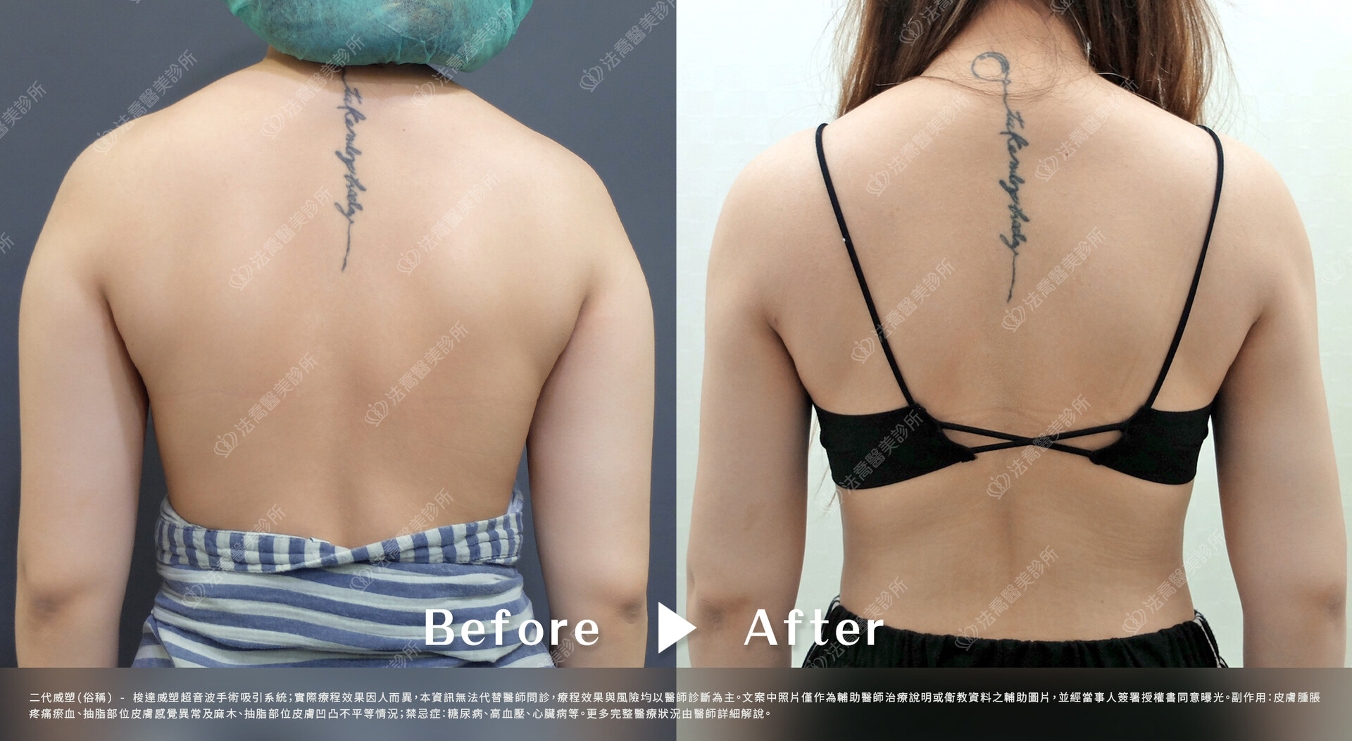 法喬醫美診所,▲威塑(俗稱)手臂環抽