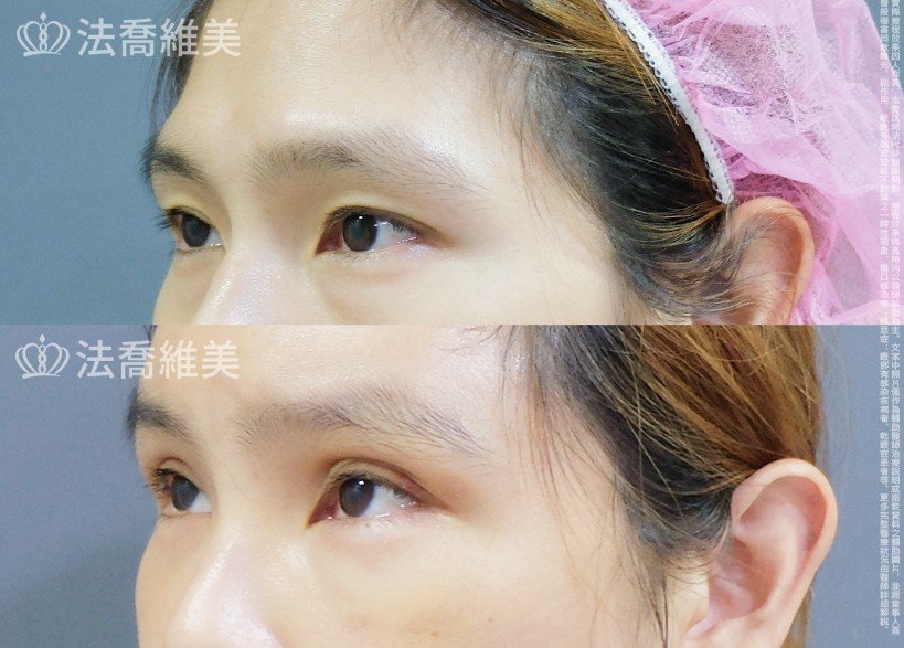 三切口雙眼皮