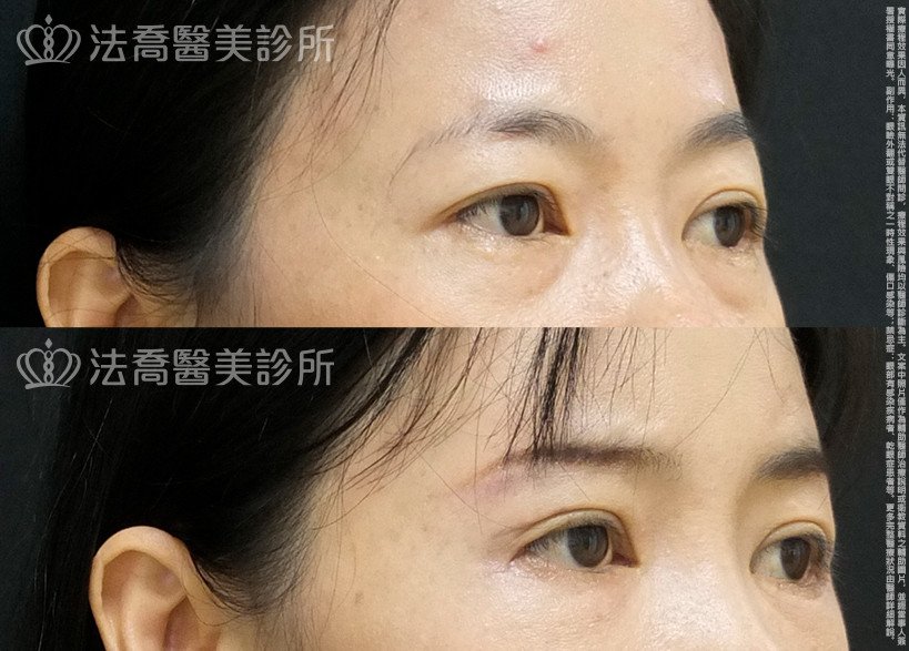 法喬醫美診所,邱浚彥,自體脂肪豐全臉,切眉,眼袋外開
