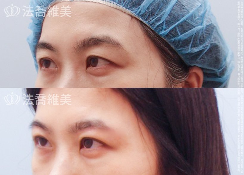 法喬醫美診所,邱浚彥,切眉