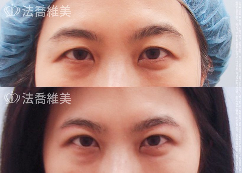 法喬醫美診所,邱浚彥,切眉