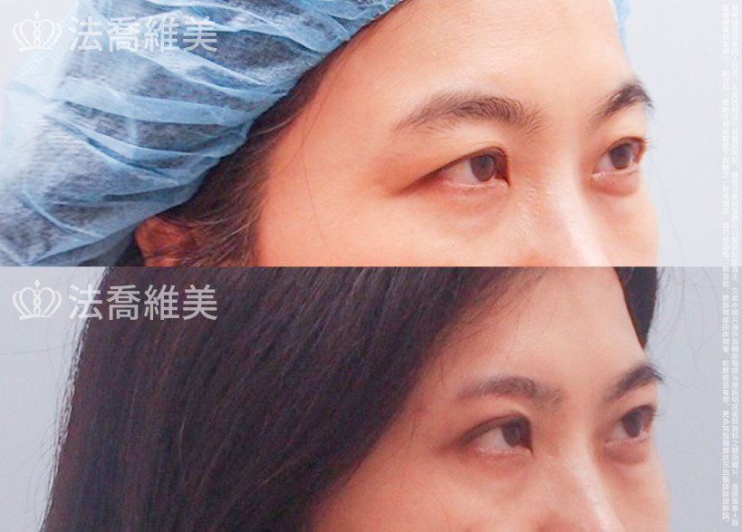 法喬醫美診所,邱浚彥,切眉