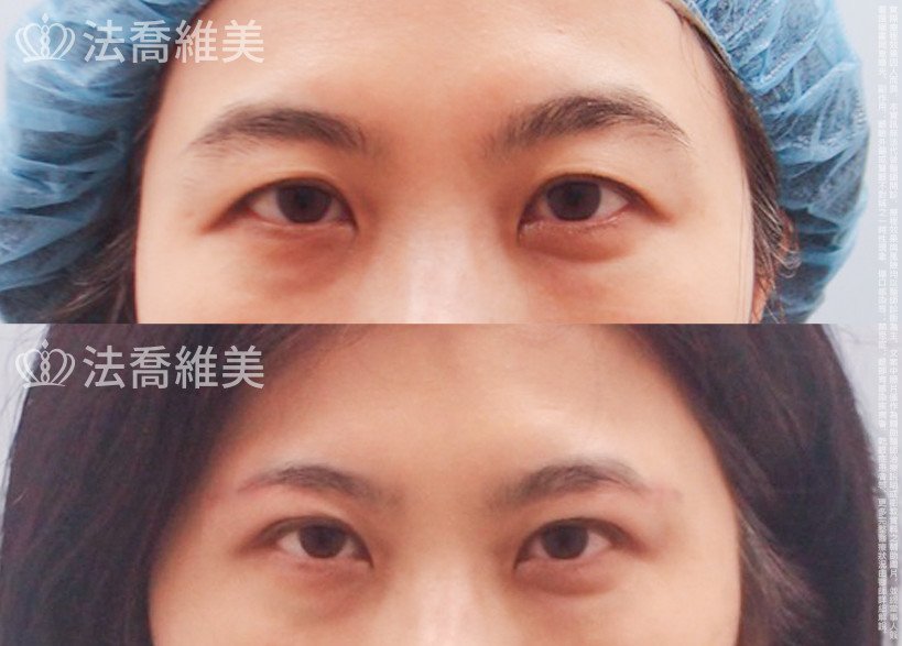 法喬醫美診所,邱浚彥,切眉