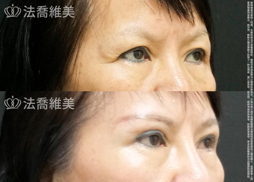 法喬醫美診所,邱浚彥,切眉