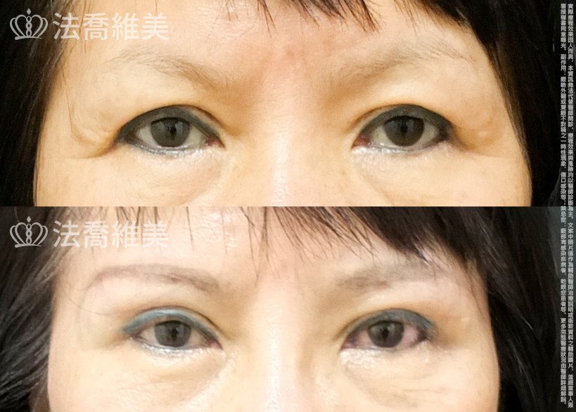 法喬醫美診所,邱浚彥,切眉