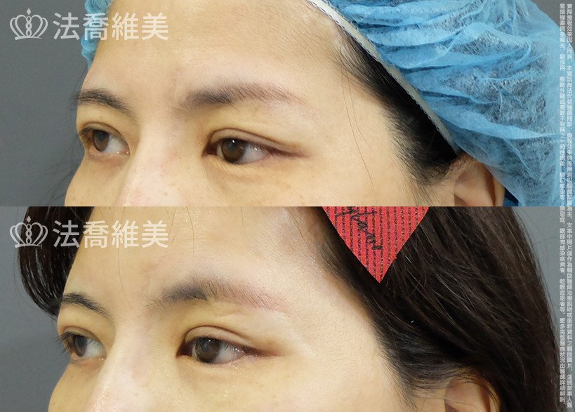 法喬醫美診所,邱浚彥,切眉