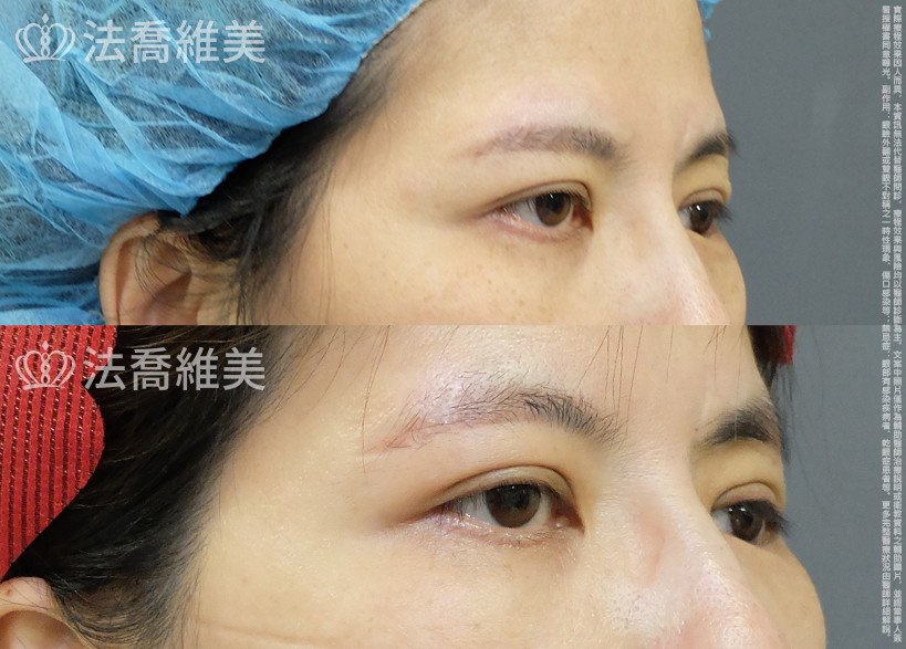 法喬醫美診所,邱浚彥,切眉