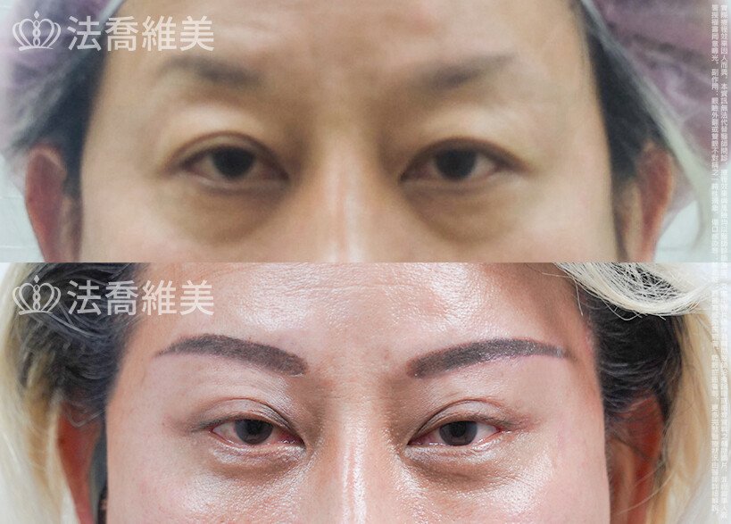 法喬醫美診所 邱浚彥醫師,切眉