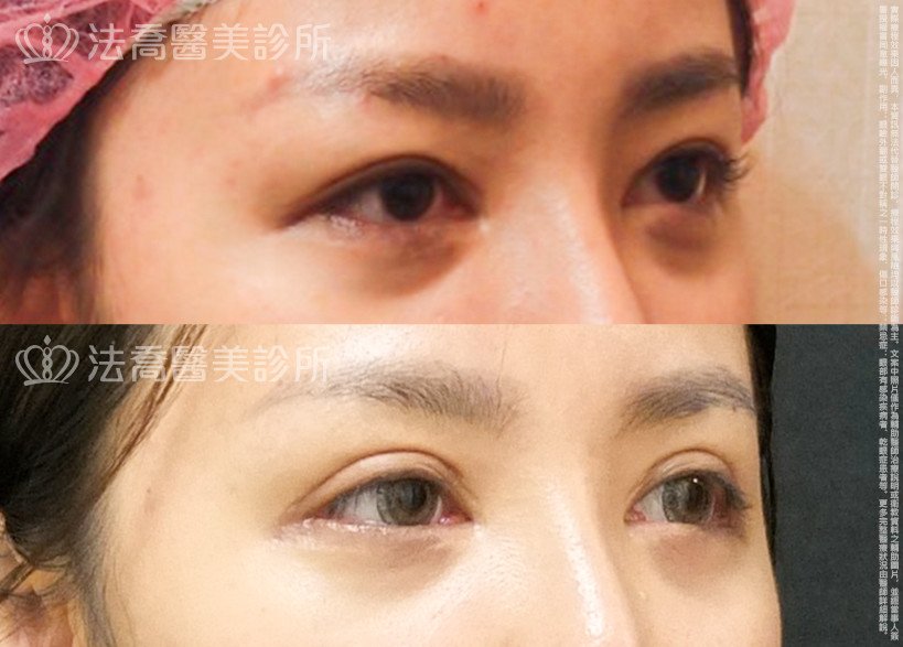 法喬醫美診所,邱浚彥,割雙眼皮,開眼頭,開眼尾