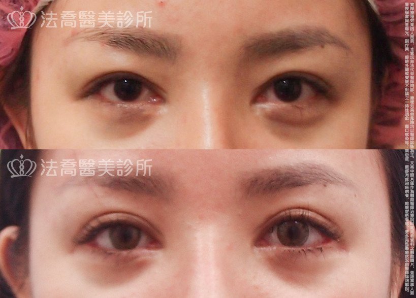 法喬醫美診所,邱浚彥,割雙眼皮,開眼頭,開眼尾