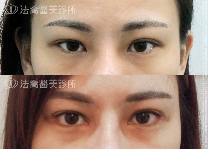 法喬醫美診所,邱浚彥,割雙眼皮,開眼頭,開眼尾