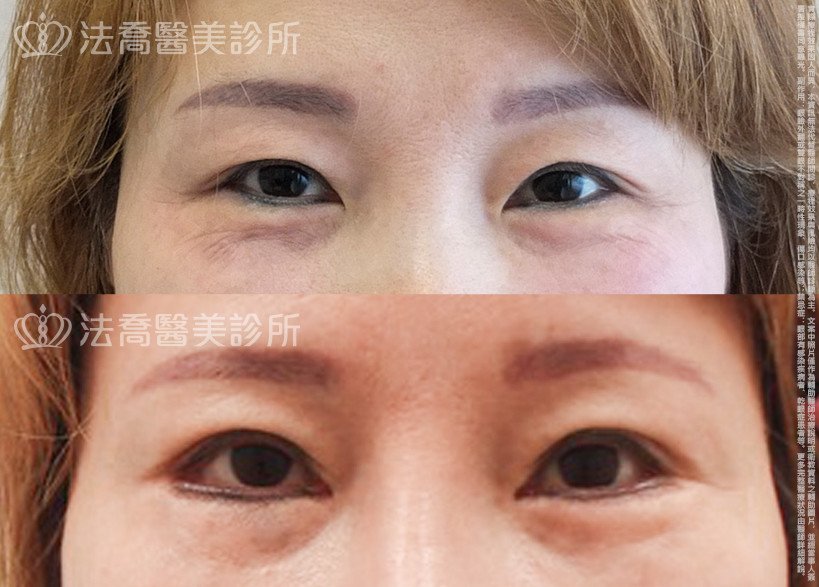 法喬醫美診所,邱浚彥,切眉