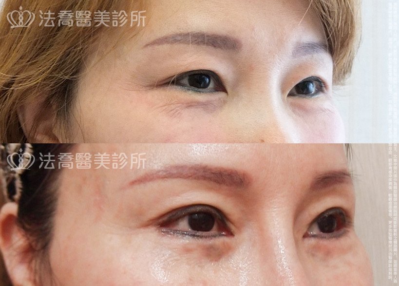 法喬醫美診所,邱浚彥,切眉