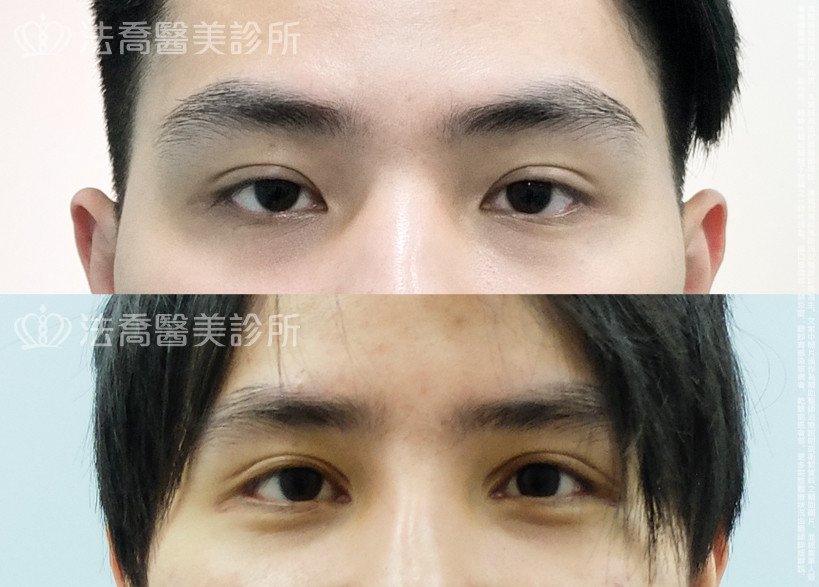 法喬醫美診所,邱浚彥,割雙眼皮,開眼頭,開眼尾