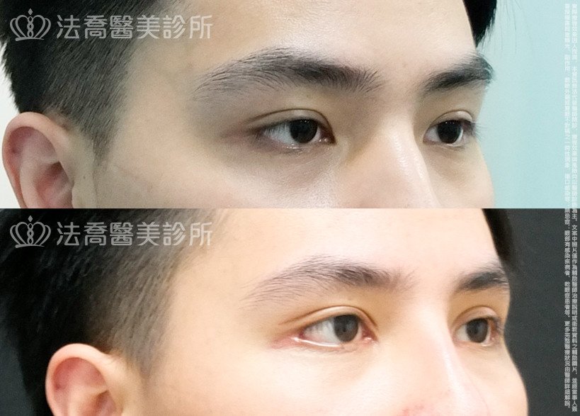 法喬醫美診所,邱浚彥,割雙眼皮,開眼頭,開眼尾