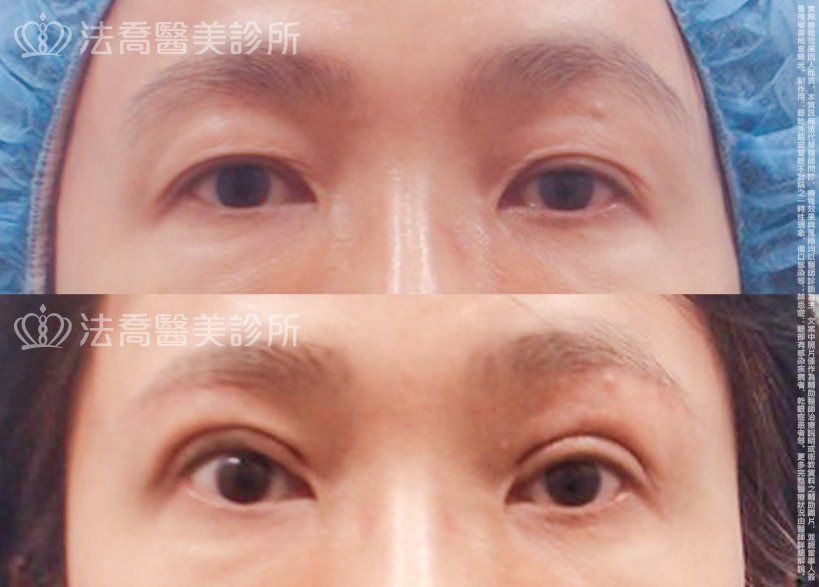 法喬醫美診所,邱浚彥,割雙眼皮