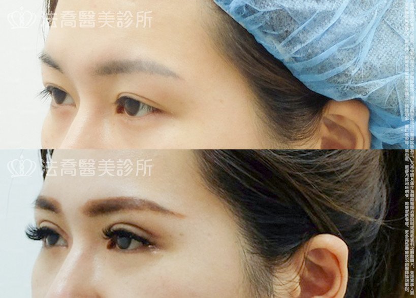 法喬醫美診所,邱浚彥,割雙眼皮