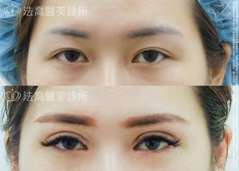 法喬醫美診所,邱浚彥,割雙眼皮