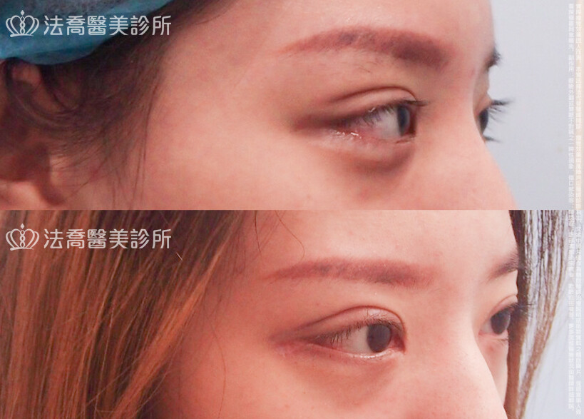法喬醫美診所,邱浚彥,割雙眼皮,開眼頭,開眼尾
