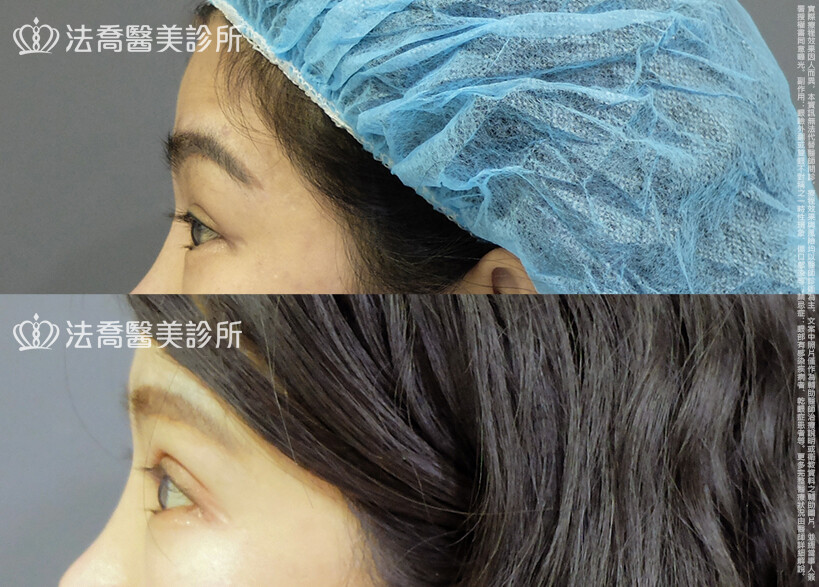 法喬醫美診所,邱浚彥,割雙眼皮,眼瞼肌提拉術,開眼頭,開眼尾