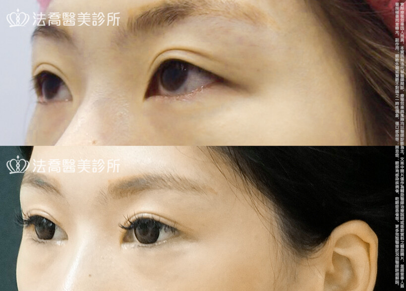 法喬醫美診所,邱浚彥,割雙眼皮,眼瞼肌提拉術,開眼頭,開眼尾